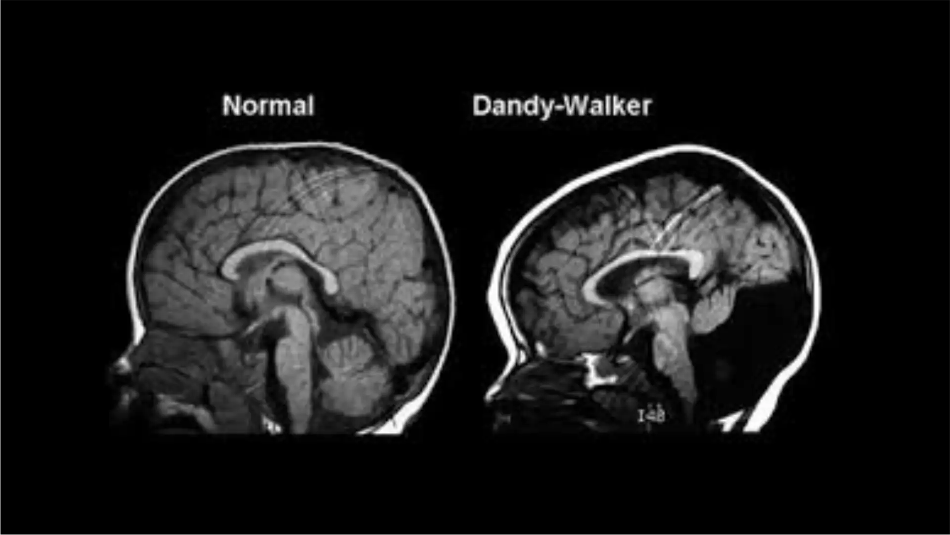Síndrome de Dandy-Walker: sintomas, diagnóstico e tratamento